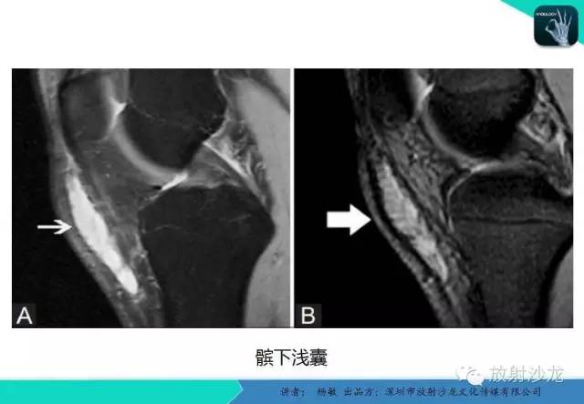 【PPT】滑囊