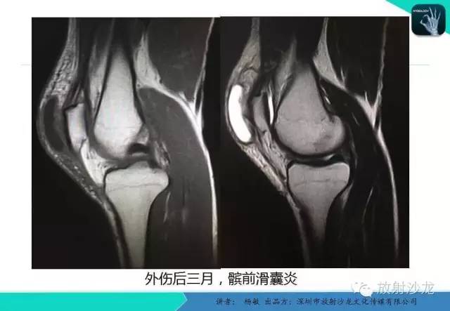 【PPT】滑囊