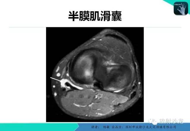 【PPT】滑囊