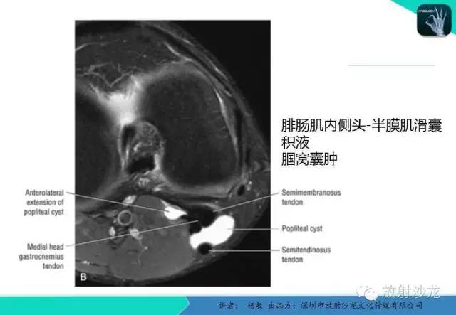 【PPT】滑囊