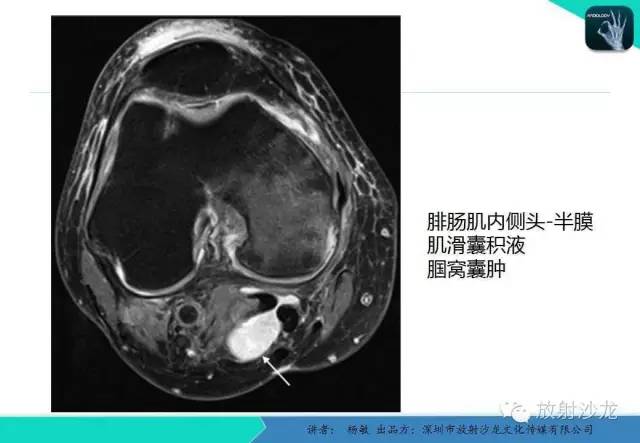 【PPT】滑囊