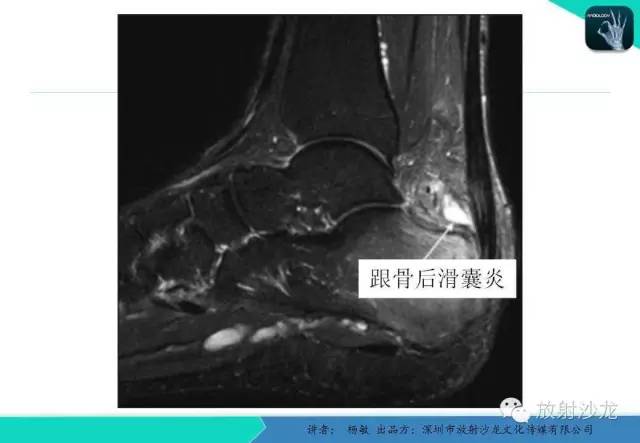 【PPT】滑囊