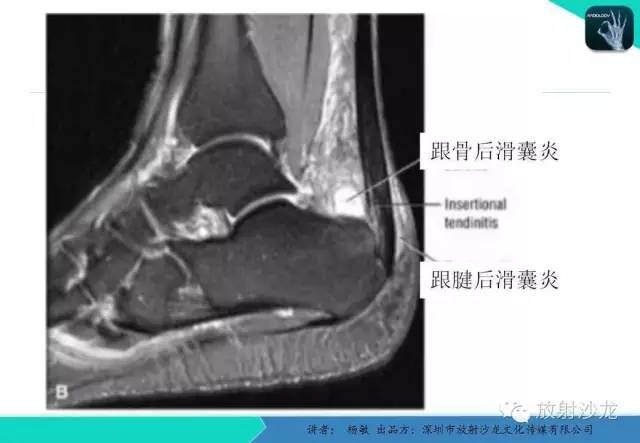 【PPT】滑囊