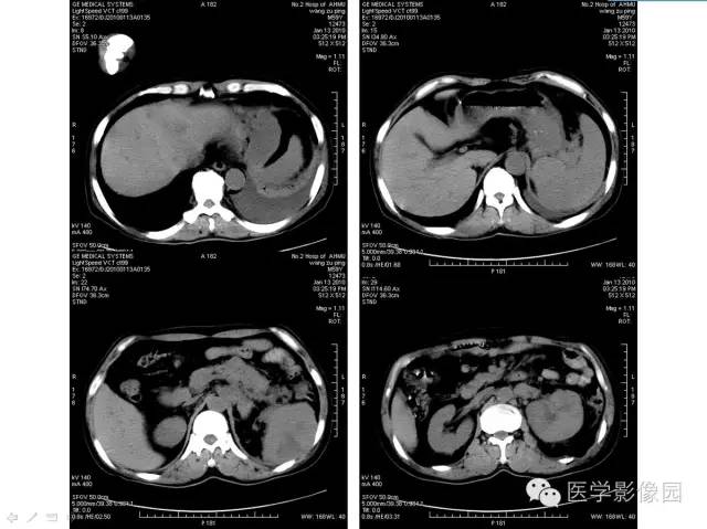 【病例】多发性骨髓瘤1例CT影像表现