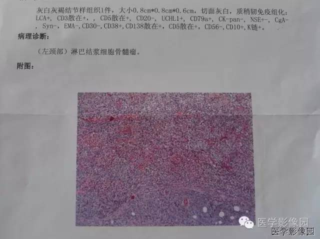 【病例】多发性骨髓瘤1例CT影像表现