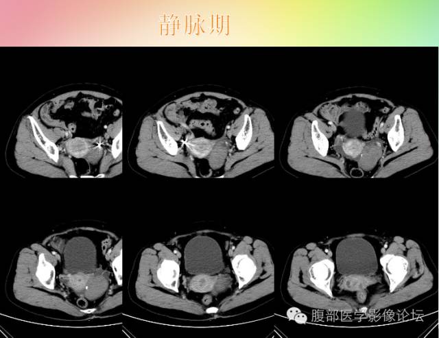 【病例】卵巢卵泡膜纤维瘤1例CT影像表现