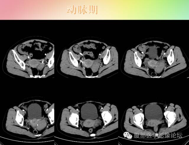 【病例】卵巢卵泡膜纤维瘤1例CT影像表现