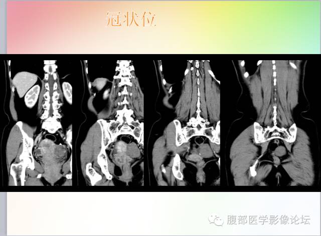 【病例】卵巢卵泡膜纤维瘤1例CT影像表现