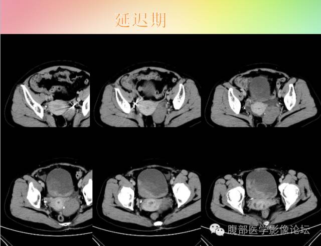 【病例】卵巢卵泡膜纤维瘤1例CT影像表现