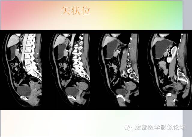 【病例】卵巢卵泡膜纤维瘤1例CT影像表现
