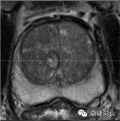 前列腺影像结构式报告