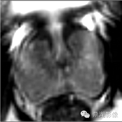 前列腺影像结构式报告