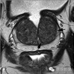 前列腺影像结构式报告