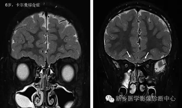 儿童12对颅神经病变解析
