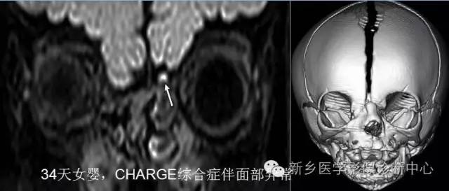 儿童12对颅神经病变解析 儿童12对颅神经病变解析