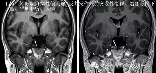 儿童12对颅神经病变解析 儿童12对颅神经病变解析