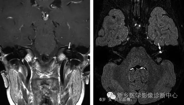 儿童12对颅神经病变解析 儿童12对颅神经病变解析
