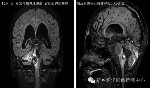 儿童12对颅神经病变解析 儿童12对颅神经病变解析
