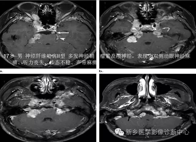 儿童12对颅神经病变解析 儿童12对颅神经病变解析