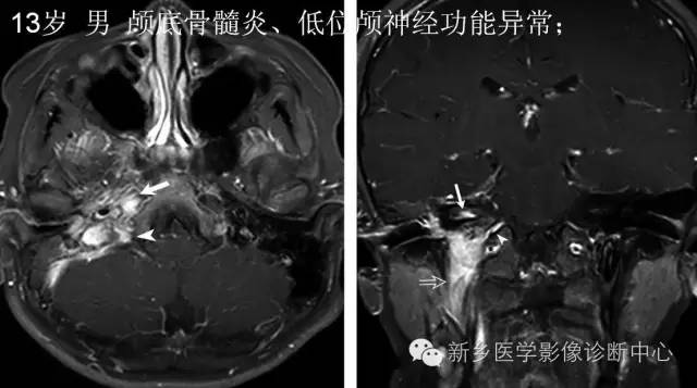 儿童12对颅神经病变解析 儿童12对颅神经病变解析