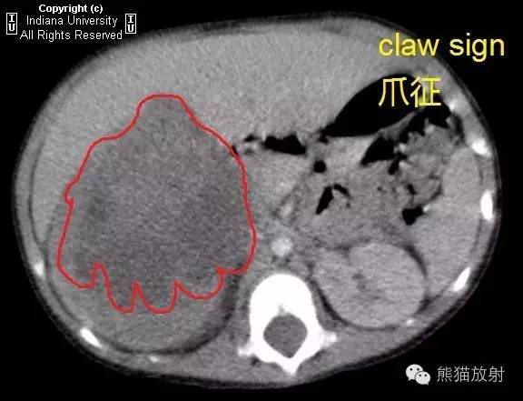 【双语病例】肾母细胞瘤(Wilms瘤)1例CT影像表现 【双语病例】肾母细胞瘤(Wilms瘤)1例CT影像表现