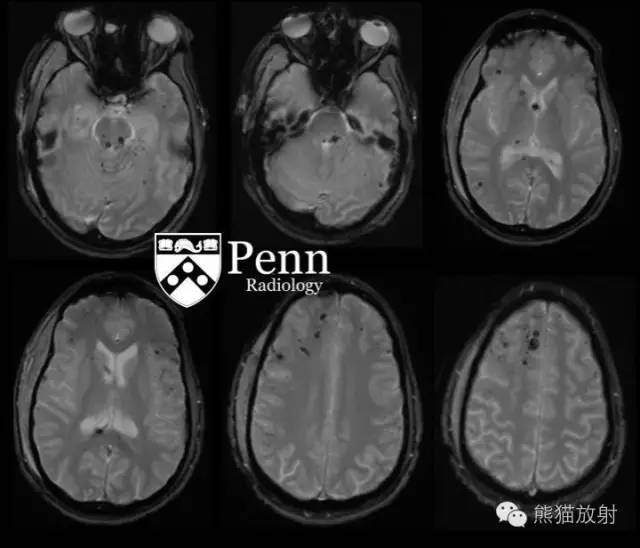 【双语病例】弥漫性轴索损伤DAI一例CT及MR影像表现 【双语病例】弥漫性轴索损伤DAI一例CT及MR影像表现