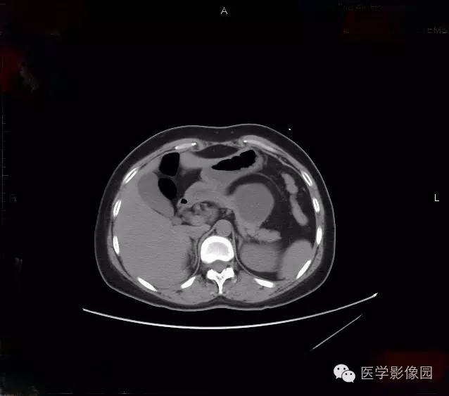 【病例】胰腺浆液性囊腺瘤1例CT影像表现