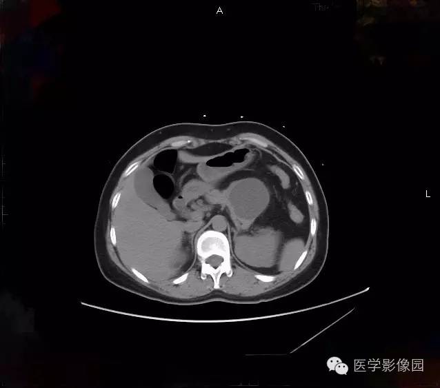 【病例】胰腺浆液性囊腺瘤1例CT影像表现 【病例】胰腺浆液性囊腺瘤1例CT影像表现