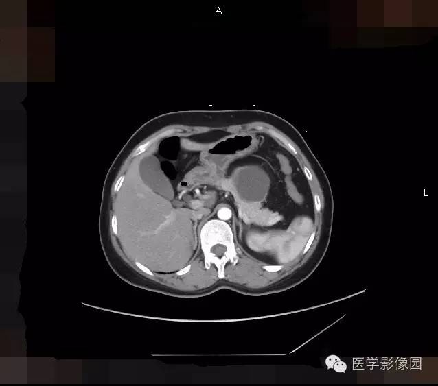 【病例】胰腺浆液性囊腺瘤1例CT影像表现 【病例】胰腺浆液性囊腺瘤1例CT影像表现