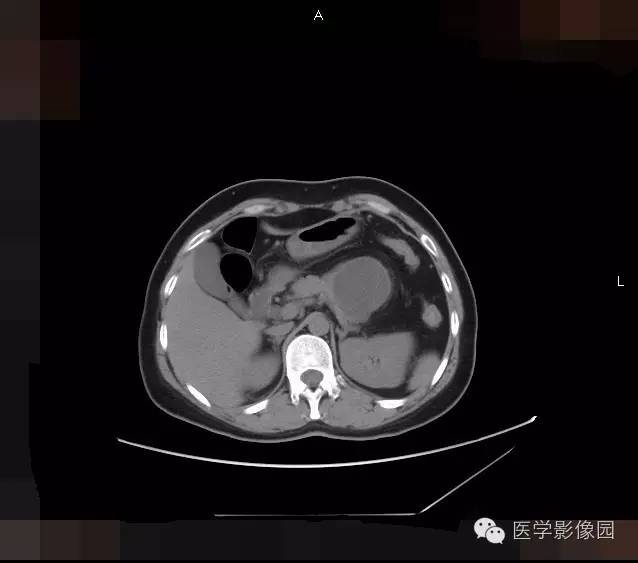 【病例】胰腺浆液性囊腺瘤1例CT影像表现 【病例】胰腺浆液性囊腺瘤1例CT影像表现
