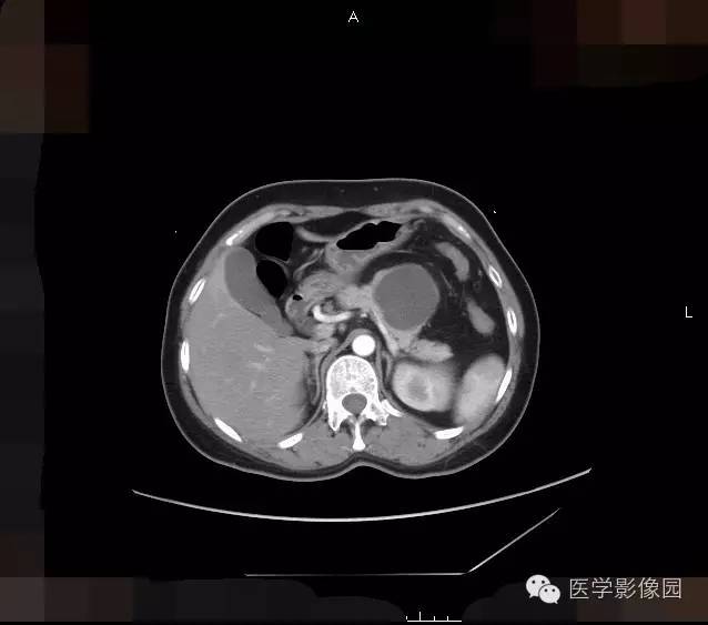 【病例】胰腺浆液性囊腺瘤1例CT影像表现 【病例】胰腺浆液性囊腺瘤1例CT影像表现