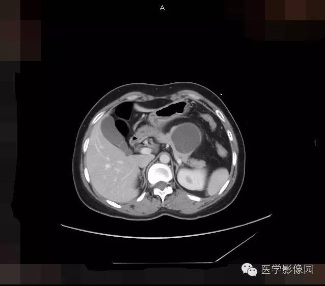 【病例】胰腺浆液性囊腺瘤1例CT影像表现 【病例】胰腺浆液性囊腺瘤1例CT影像表现