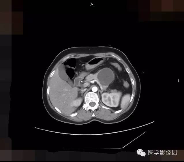 【病例】胰腺浆液性囊腺瘤1例CT影像表现 【病例】胰腺浆液性囊腺瘤1例CT影像表现