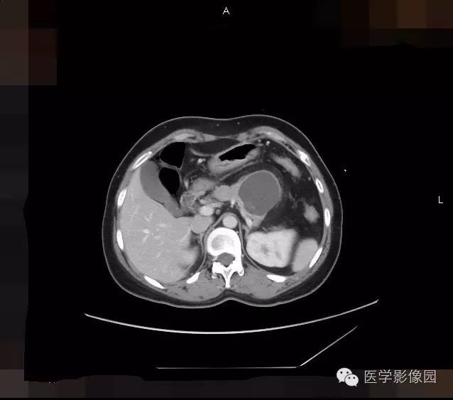 【病例】胰腺浆液性囊腺瘤1例CT影像表现 【病例】胰腺浆液性囊腺瘤1例CT影像表现