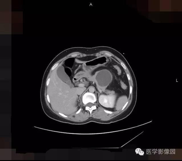 【病例】胰腺浆液性囊腺瘤1例CT影像表现 【病例】胰腺浆液性囊腺瘤1例CT影像表现