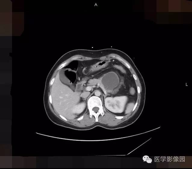 【病例】胰腺浆液性囊腺瘤1例CT影像表现 【病例】胰腺浆液性囊腺瘤1例CT影像表现