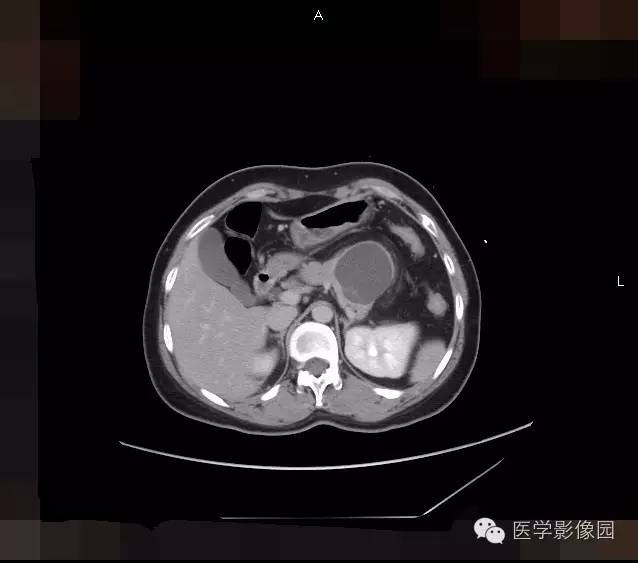【病例】胰腺浆液性囊腺瘤1例CT影像表现 【病例】胰腺浆液性囊腺瘤1例CT影像表现
