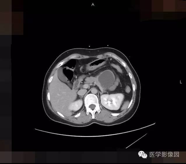 【病例】胰腺浆液性囊腺瘤1例CT影像表现 【病例】胰腺浆液性囊腺瘤1例CT影像表现