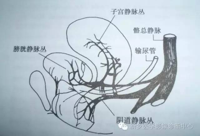工作中,看到盆腔静脉曲张,别忽略了这个病 工作中,看到盆腔静脉曲张,别忽略了这个病