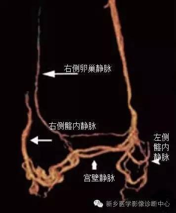 工作中,看到盆腔静脉曲张,别忽略了这个病 工作中,看到盆腔静脉曲张,别忽略了这个病