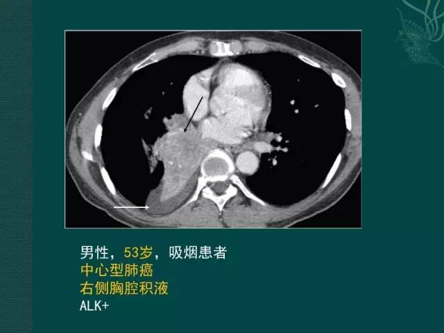 【PPT】非小细胞肺癌 EGFR 基因突变的影像学诊断文献复习