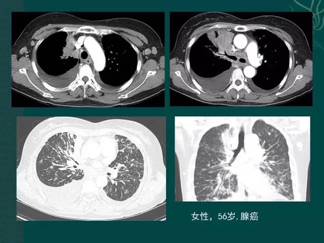 【PPT】非小细胞肺癌 EGFR 基因突变的影像学诊断文献复习