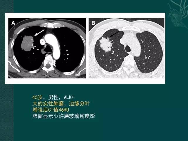 【PPT】非小细胞肺癌 EGFR 基因突变的影像学诊断文献复习