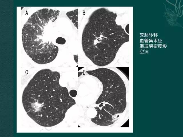 【PPT】非小细胞肺癌 EGFR 基因突变的影像学诊断文献复习