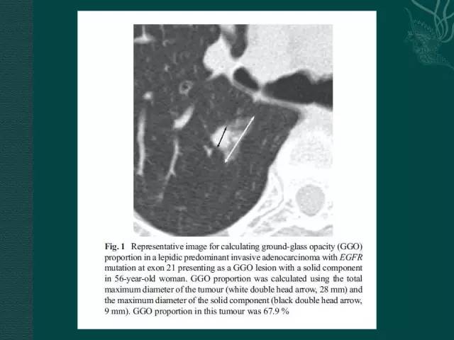 【PPT】非小细胞肺癌 EGFR 基因突变的影像学诊断文献复习
