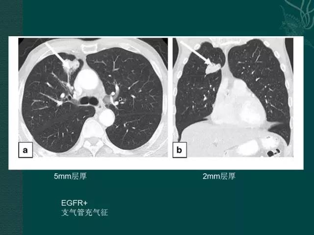 【PPT】非小细胞肺癌 EGFR 基因突变的影像学诊断文献复习