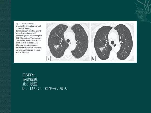 【PPT】非小细胞肺癌 EGFR 基因突变的影像学诊断文献复习