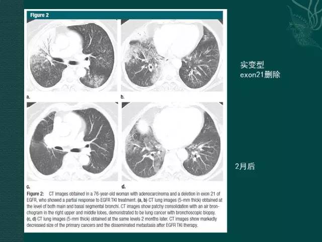 【PPT】非小细胞肺癌 EGFR 基因突变的影像学诊断文献复习