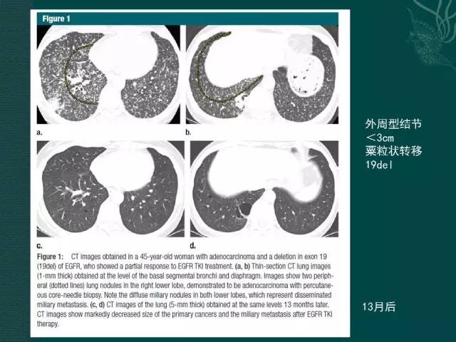 【PPT】非小细胞肺癌 EGFR 基因突变的影像学诊断文献复习