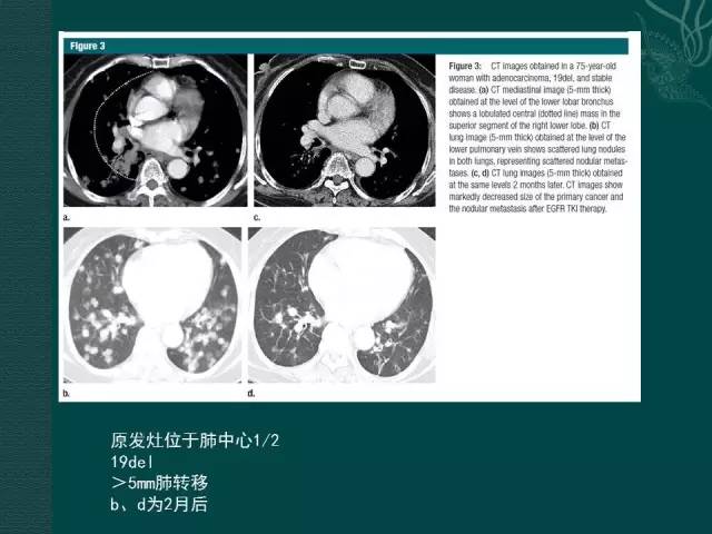 【PPT】非小细胞肺癌 EGFR 基因突变的影像学诊断文献复习